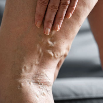 Varicose Veins Treatment