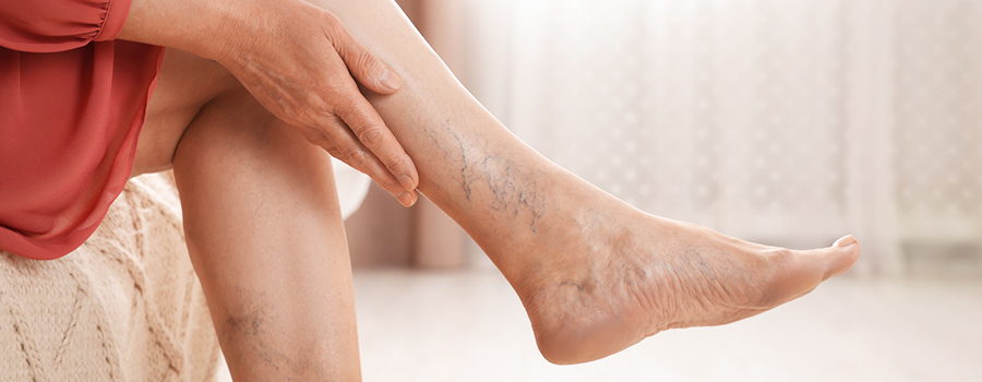 Varicose Veins Treatment in Siliguri